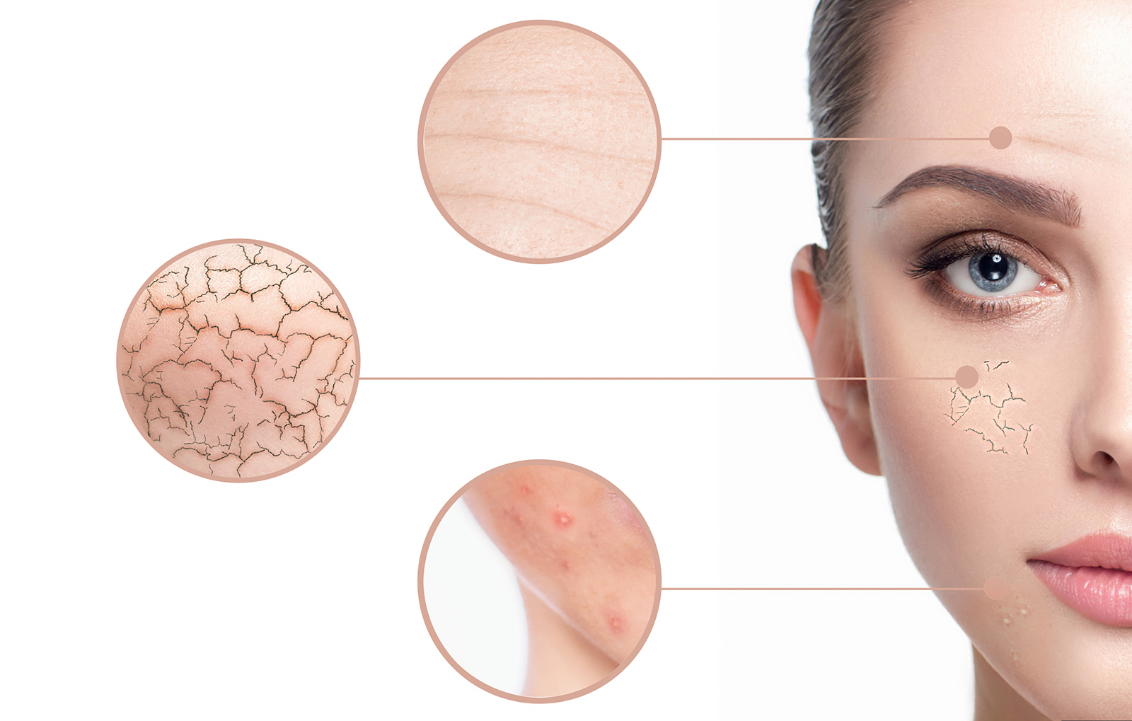Close-up illustration of acne-prone skin with dryness, irritation, and blemishes highlighted — ORY Skincare solutions for breakout-prone complexions.