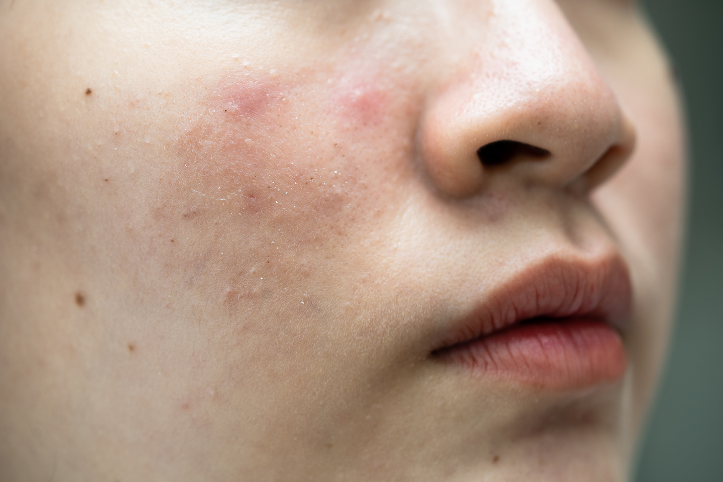 Close-up of acne-prone skin with redness, clogged pores, and blemishes — ORY Skincare solutions for breakout-prone complexions.