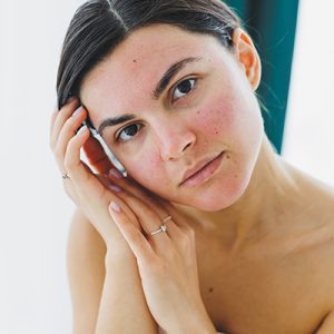 Woman with acne-prone, irritated skin preparing to apply soothing balancing toner — ORY Skincare toner for acne-prone skin.